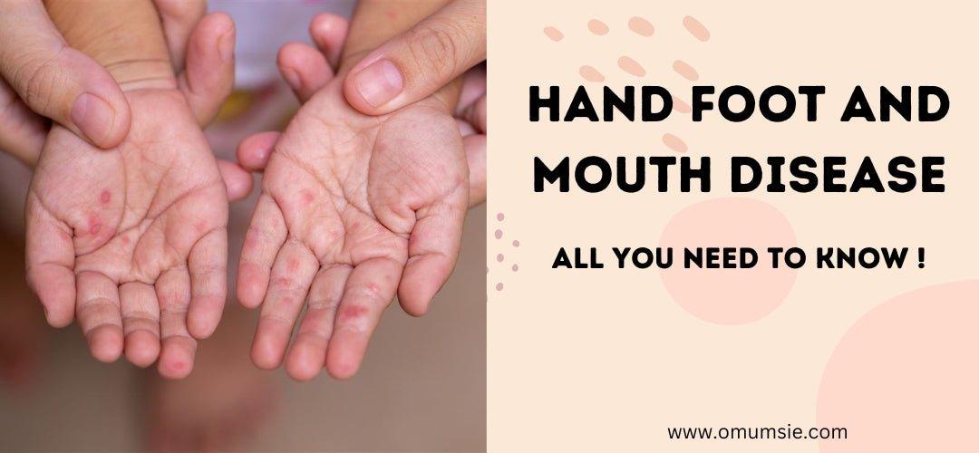 Guide to Hand Foot and Mouth Disease in Kids – omumsie